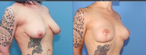 Breast Lift Before & After Gallery - Patient 58179115 - Image 4