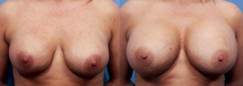 Breast Revision Before & After Gallery - Patient 58179114 - Image 1