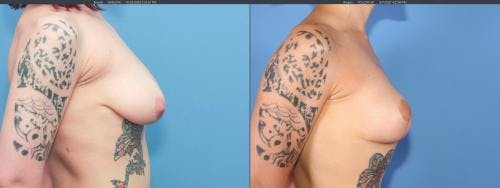 Breast Lift Before & After Gallery - Patient 58179115 - Image 5
