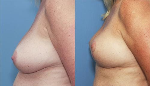 Breast Lift Before & After Gallery - Patient 58179117 - Image 2