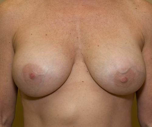 Breast Revision Before & After Gallery - Patient 58179116 - Image 2