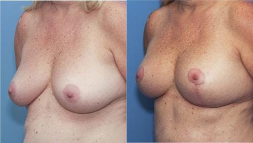 Breast Lift Before & After Gallery - Patient 58179117 - Image 3