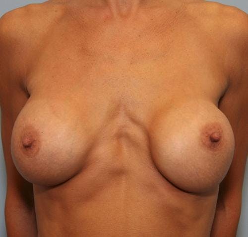 Breast Implant Revision Before & After Gallery - Patient 58179119 - Image 1