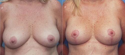 Breast Lift Before & After Gallery - Patient 58179117 - Image 1