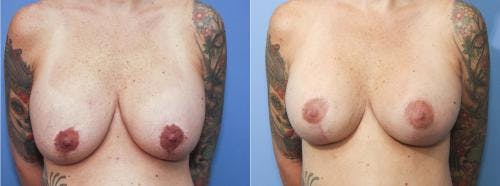 Breast Lift Before & After Gallery - Patient 58179118 - Image 1