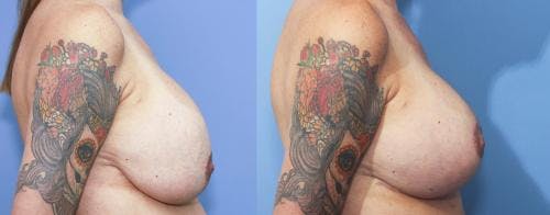 Breast Lift Before & After Gallery - Patient 58179118 - Image 2