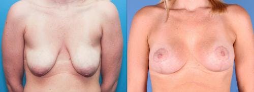 Breast Lift with Augmentation Before & After Gallery - Patient 58179121 - Image 1