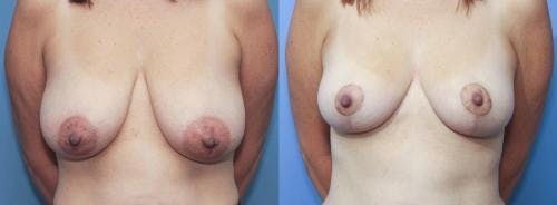 Breast Lift Before & After Gallery - Patient 58179120 - Image 1