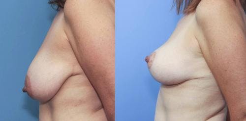 Breast Lift Before & After Gallery - Patient 58179120 - Image 2