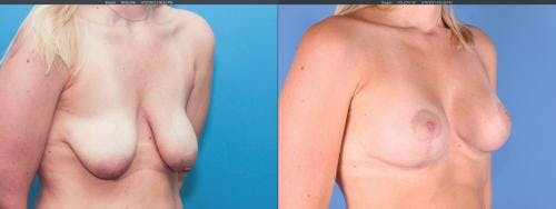 Breast Lift with Augmentation Before & After Gallery - Patient 58179121 - Image 3