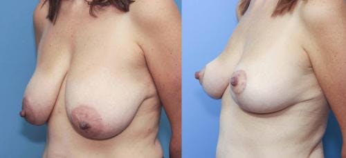 Breast Lift Before & After Gallery - Patient 58179120 - Image 3