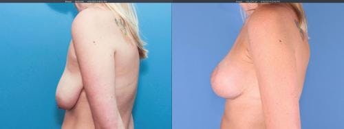 Breast Lift with Augmentation Before & After Gallery - Patient 58179121 - Image 4