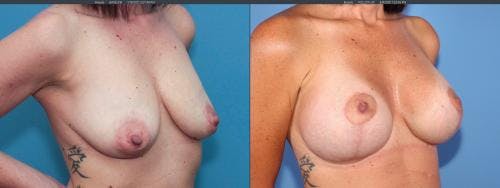Breast Lift with Augmentation Before & After Gallery - Patient 58179123 - Image 2
