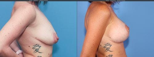 Breast Lift with Augmentation Before & After Gallery - Patient 58179123 - Image 3