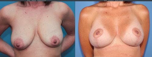 Breast Lift with Augmentation Before & After Gallery - Patient 58179123 - Image 1