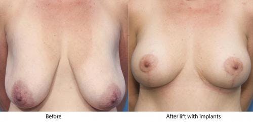 Breast Lift Before & After Gallery - Patient 58179122 - Image 1