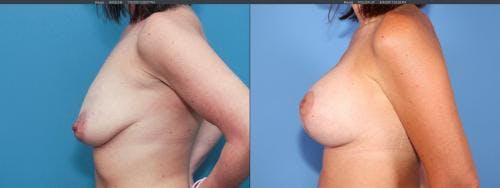 Breast Lift with Augmentation Before & After Gallery - Patient 58179123 - Image 5