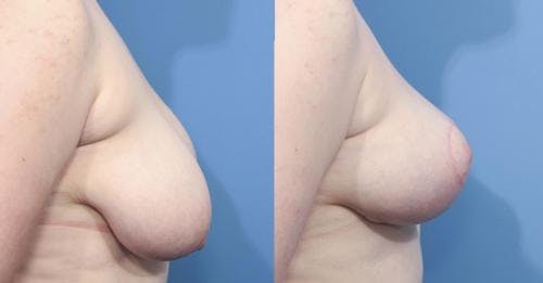 Breast Lift Before & After Gallery - Patient 58179125 - Image 2