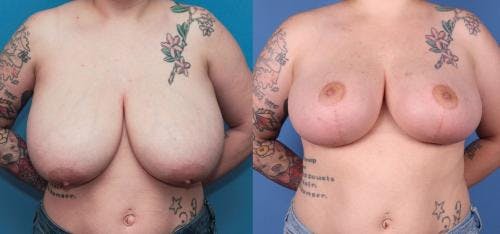 Breast Reduction Before & After Gallery - Patient 58179126 - Image 1
