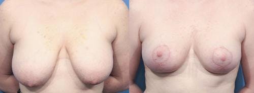 Breast Lift Before & After Gallery - Patient 58179125 - Image 1