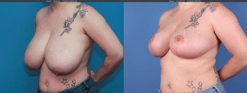 Breast Reduction Before & After Gallery - Patient 58179126 - Image 2