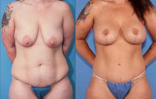 Breast Lift with Augmentation Before & After Gallery - Patient 58179128 - Image 2