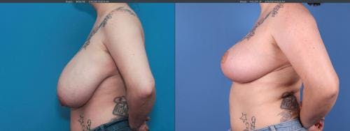 Breast Reduction Before & After Gallery - Patient 58179126 - Image 3