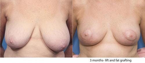 Breast Lift Before & After Gallery - Patient 58179127 - Image 1