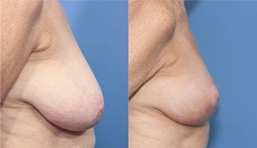Breast Lift Before & After Gallery - Patient 58179127 - Image 2