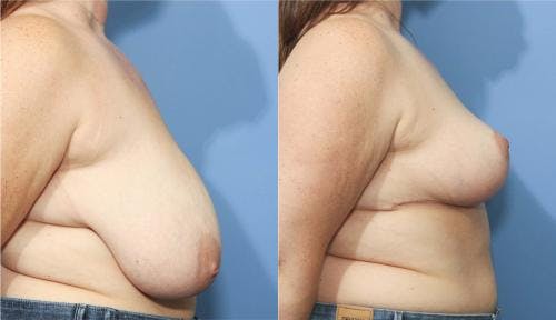 Breast Reduction Before & After Gallery - Patient 58179129 - Image 2