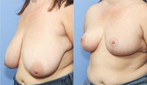 Breast Reduction Before & After Gallery - Patient 58179129 - Image 3