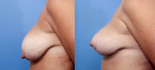 Breast Lift Before & After Gallery - Patient 58179131 - Image 2