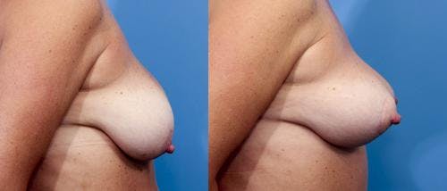 Breast Lift Before & After Gallery - Patient 58179131 - Image 3