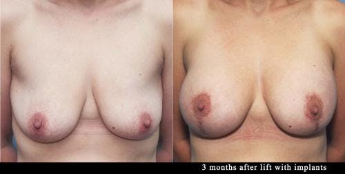Breast Lift with Augmentation Before & After Gallery - Patient 58179132 - Image 1