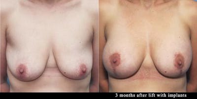 Breast Lift with Augmentation Before & After Gallery - Patient 58179132 - Image 1