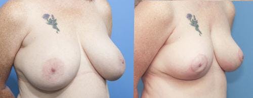 Breast Reduction Before & After Gallery - Patient 58179134 - Image 2
