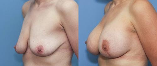 Breast Lift with Augmentation Before & After Gallery - Patient 58179132 - Image 2