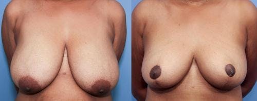 Breast Lift Before & After Gallery - Patient 58179133 - Image 1