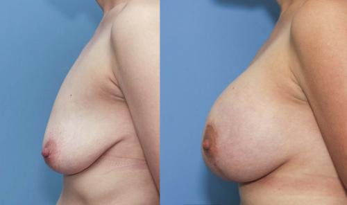 Breast Lift with Augmentation Before & After Gallery - Patient 58179132 - Image 3