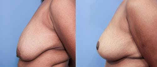 Breast Lift Before & After Gallery - Patient 58179133 - Image 2