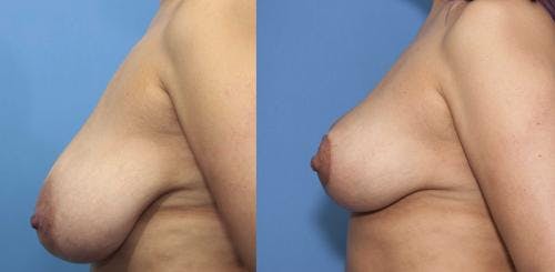 Breast Reduction Before & After Gallery - Patient 58179136 - Image 2