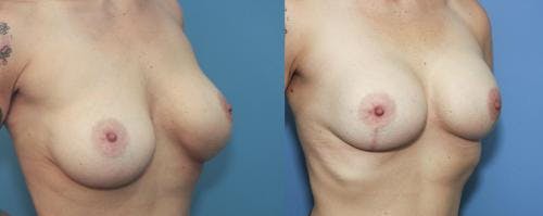 Breast Lift with Augmentation Before & After Gallery - Patient 58179135 - Image 2