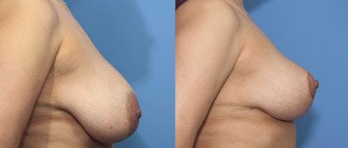Breast Reduction Before & After Gallery - Patient 58179136 - Image 3