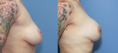Breast Lift with Augmentation Before & After Gallery - Patient 58179135 - Image 3