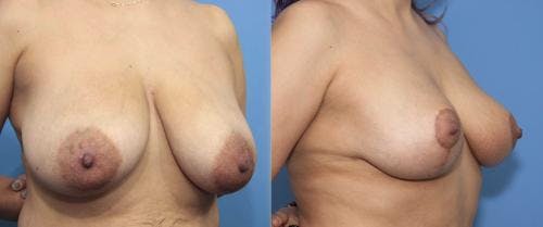 Breast Reduction Before & After Gallery - Patient 58179136 - Image 4