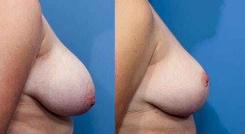 Breast Lift Before & After Gallery - Patient 58179137 - Image 3