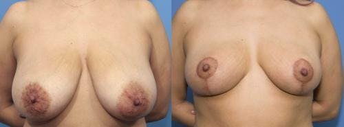 Breast Reduction Before & After Gallery - Patient 58179136 - Image 1