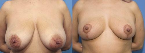 Breast Reduction