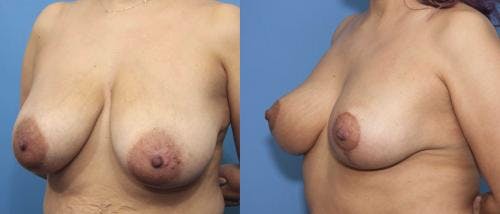 Breast Reduction Before & After Gallery - Patient 58179136 - Image 5
