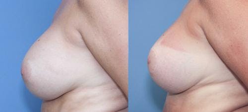 Breast Lift with Augmentation Before & After Gallery - Patient 58179138 - Image 2